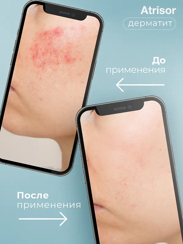 Atrisor Topical