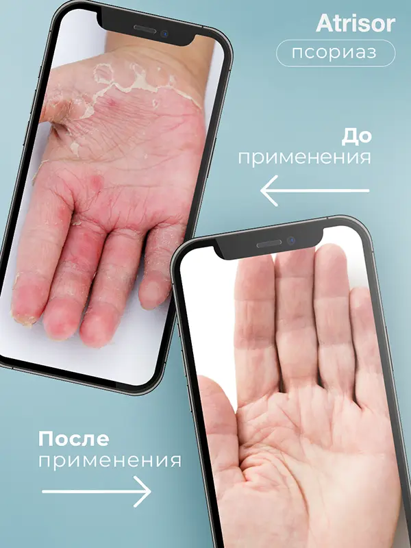 Atrisor Topical